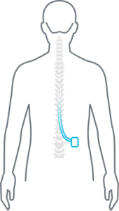 Spinal cord stimulator replacement